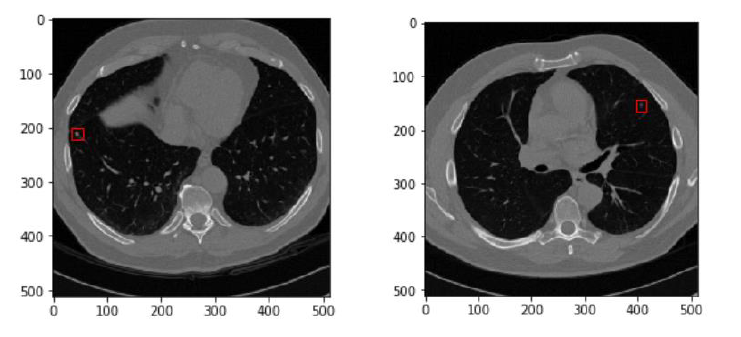 Medical image processing using Microsoft Deep Learning Framework(CNTK ...